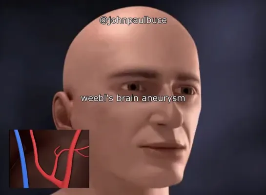 [John Paul Buce] weebl's brain aneurysm