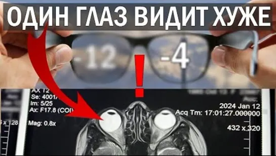 РАЗНОЕ ЗРЕНИЕ НА ГЛАЗАХ. Чем опасно? Как не допустить? И что делать если уже допустил?