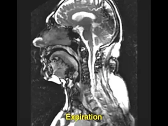 NEJM - динамическое МРТ при синдроме апноэ во сне.