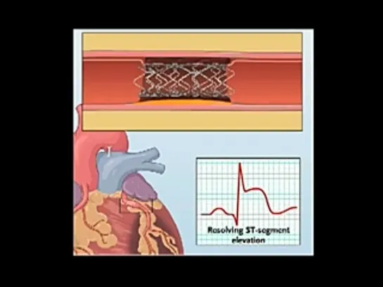 Чрескожная баллонная ангиопластика и стентирование, анимация от NEJM