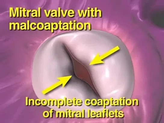 Чрезкожное вмешательство при недостаточности митрального клапана от NEJM