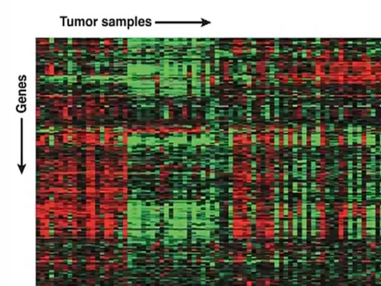 NEJM - Acute Myeloid Leukemia