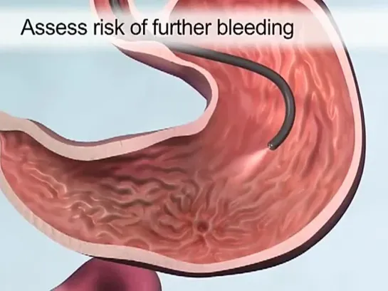 Основные методы эндоскопического гемостаза, анимация от NEJM