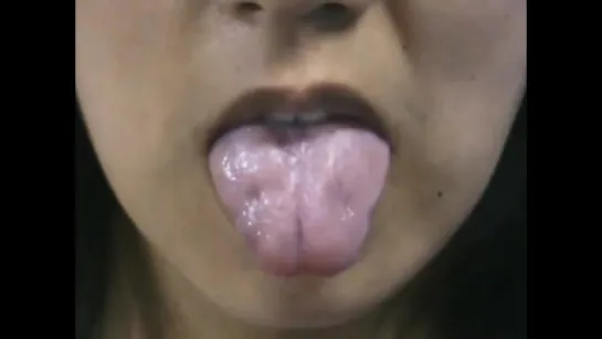 Myotonia with Percussion of the Tongue