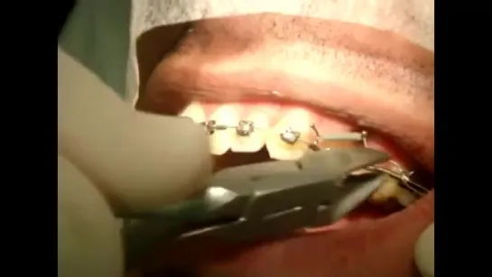 Instalação de Mini Implante para distalização de molar. Ортодонтия. Брекеты.