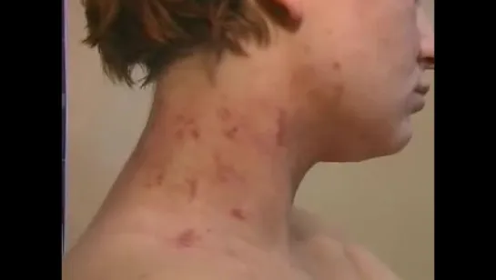 Атопический дерматит © Atopic dermatitis