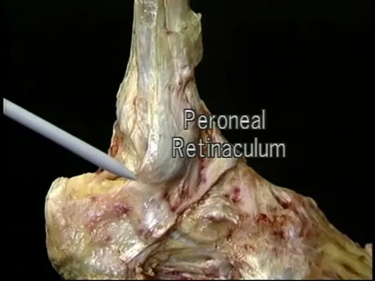 Видеоатлас анатомии Acland. Фильм 2, часть 3. Голень и лодыжка. Русский перевод А. Пилюгина.