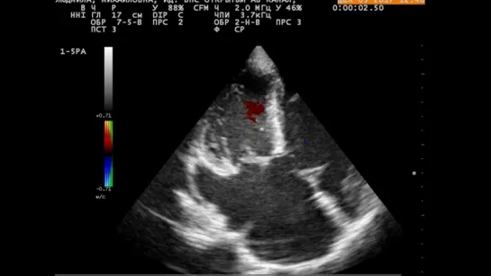 Partial AV canal (Аtrioventricular canal defects - AVSD)