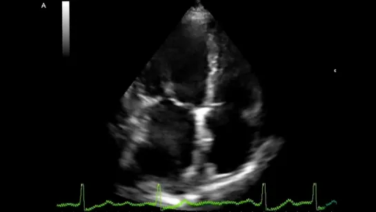 Thrombus in the left atrium - Transthoracic Echocardiogram (TTE)