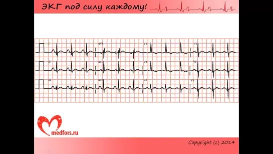 Урок 8. Видеокурс 'ЭКГ под силу каждому'.