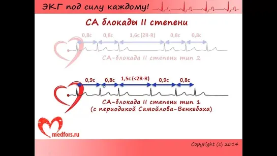 Урок 6. Видеокурс 'ЭКГ под силу каждому'.