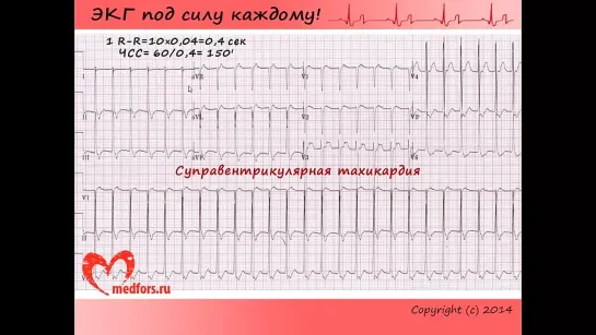 Урок 5. Видеокурс 'ЭКГ под силу каждому'.