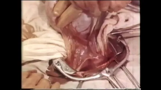 Овариоэктомия, удаление яичников при раке молочной железы © Oophorectomy, removal of the ovaries