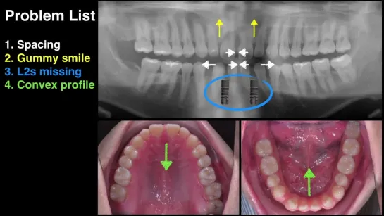 ABO Invisalign Implant Combined Case. Крис Чанг. Ортодонтия