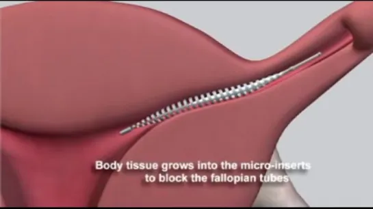 The Essure Procedure