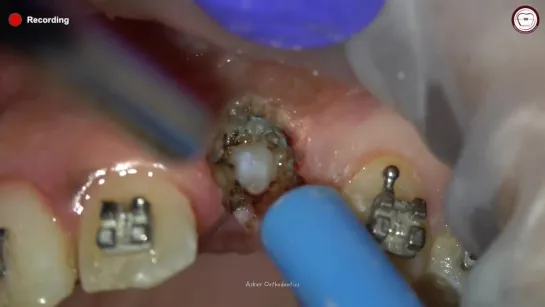 Step by step surgical exposure and orthodontic traction of impacted canine by Amr Asker