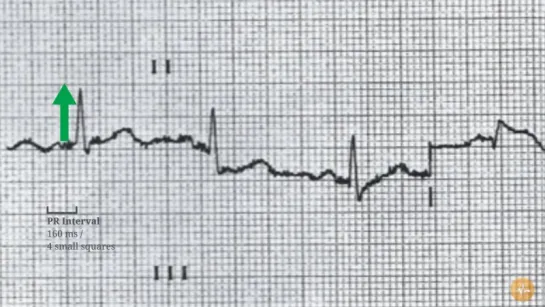 ECG Case 5 - Diabetic with Chest Discomfort