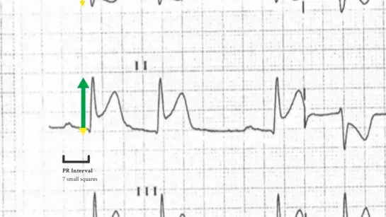 ECG Case 2 - Chest pain