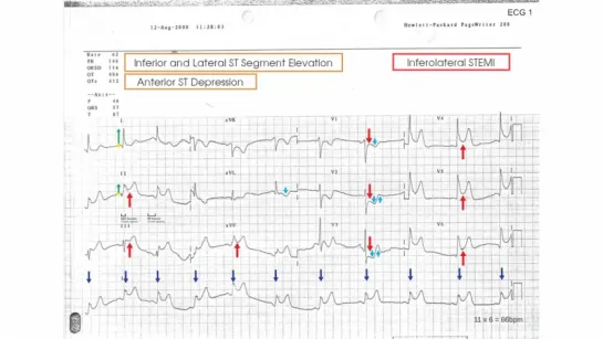 ECG Case 1 - Chest Pain in Heavy Smoker