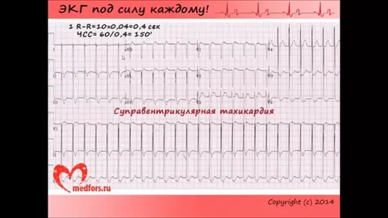 Школа ЭКГ - 5 урок.