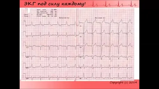 Школа ЭКГ - 7 урок.