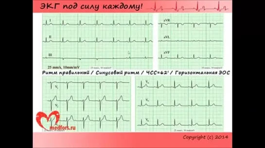 Школа ЭКГ - 4 урок.