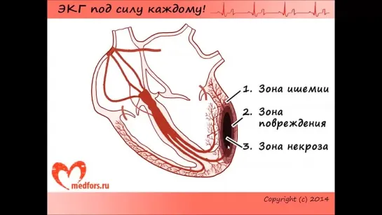 Школа ЭКГ - 9 урок