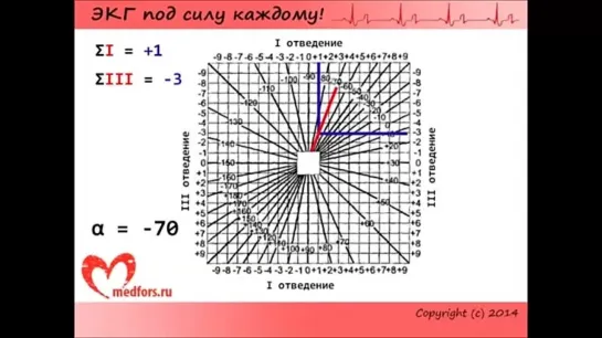 Школа ЭКГ - 3 урок