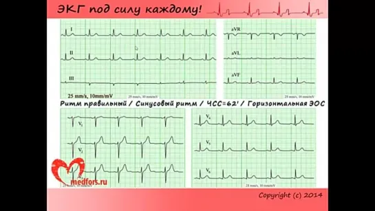 Школа ЭКГ - 4