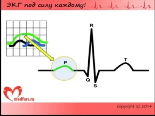 Школа ЭКГ - 2