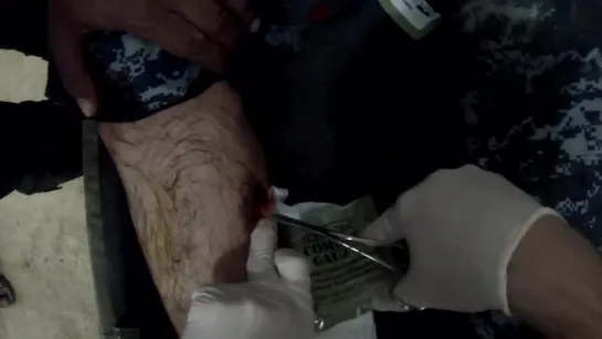 Gunshot wound to the leg