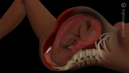 Shoulder Dystocia