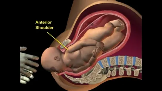 Ant. Shoulder Dystocia