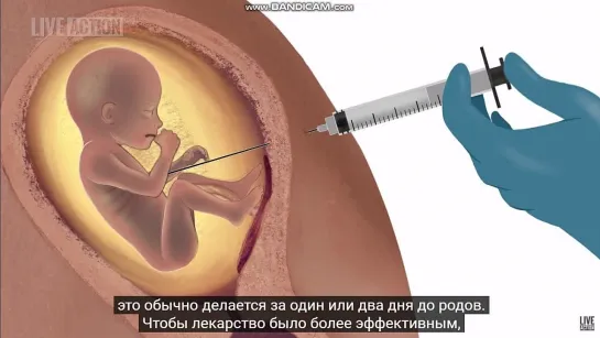 Аборт c 22 по 39 неделю. Перевод - яндекс нейросеть