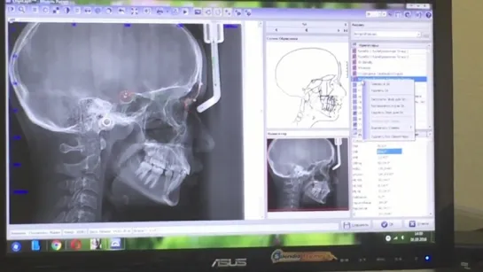 Телерентгенограмма. Установка точек в программе OnyxCeph