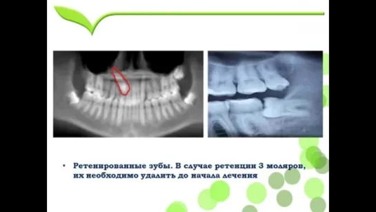 Что необходимо знать для работы с Элайнерами ОртоСнэп