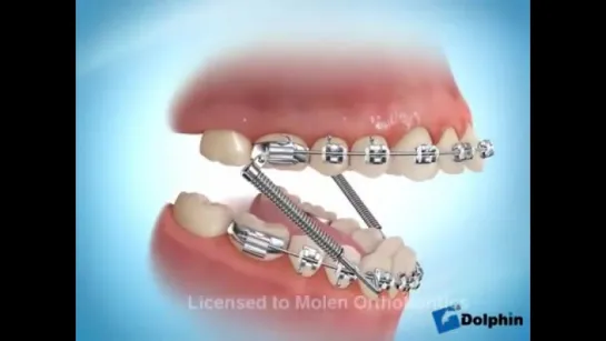 Overbite Correction in Braces