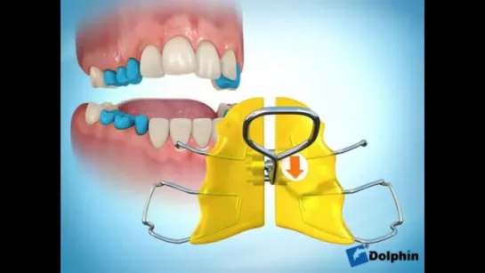 Orthodontics San Jose- Removable Expander