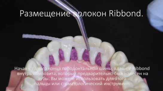 Шинирование при пародонтите при помощи Ribbond.