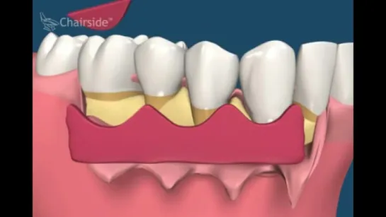 Закрытие рецессии корня. Пародонтология.