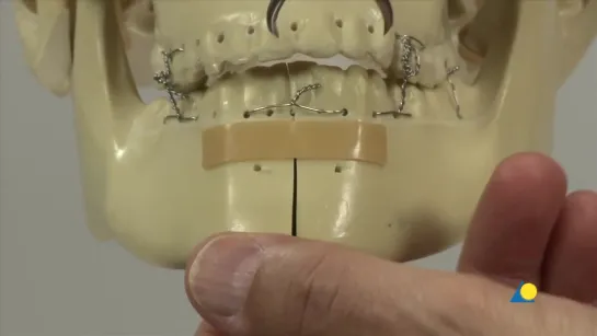 Фиксация билатерального субкондилярного перелома и симфиза нижней челюсти.Стоматология.ЧЛХ.