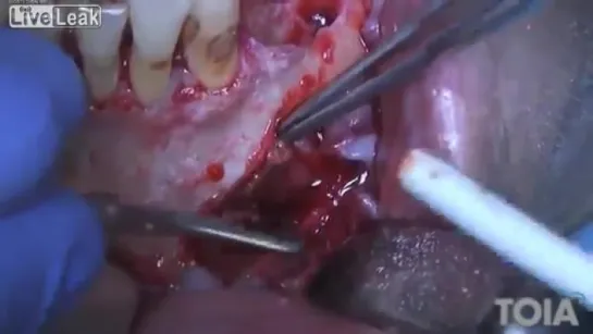 Surgical Removal of Mandibular Cyst Цистэктомия.