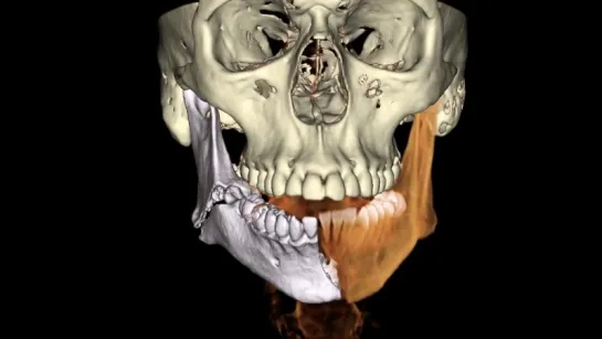 Виртуальная реконструкция перелома нижней челюсти. Хирургическая стоматология