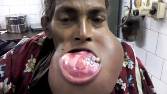 Ameloblastoma of mandible largest tumor of mandible  huge tumor. Стоматология.