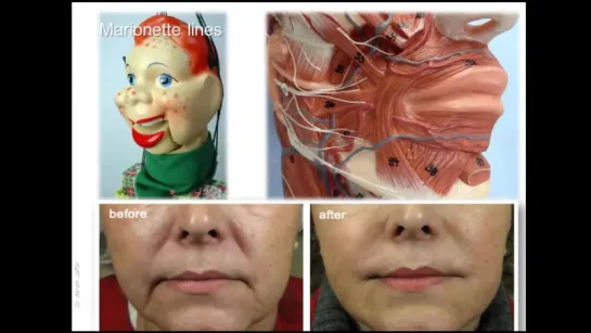 Anatomy of wrinkle lines and Botox injection sites. Анатомия.