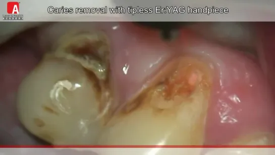 Препарирование зубов лазером. Стоматология.