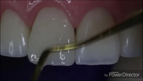 Anterior Direct composite with index technique. Эстетическая реставрация.