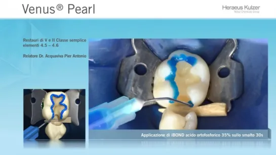 Dr. P.Acquaviva - Ricostruzione di V e II Classe. Наногибрид HERAEUS KULTZER Venus Pearl.