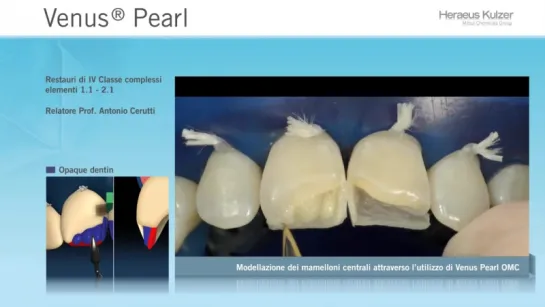 Prof. A.Cerutti - Ricostruzione di IV Classe complessa.  Наногибрид HERAEUS KULTZER Venus Pearl.