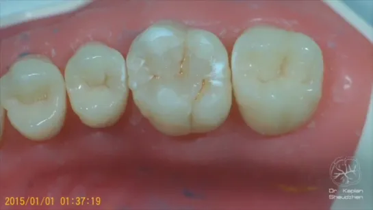 DentalПлюшки 16 - полировка реставрация. Каплан Шеуджен